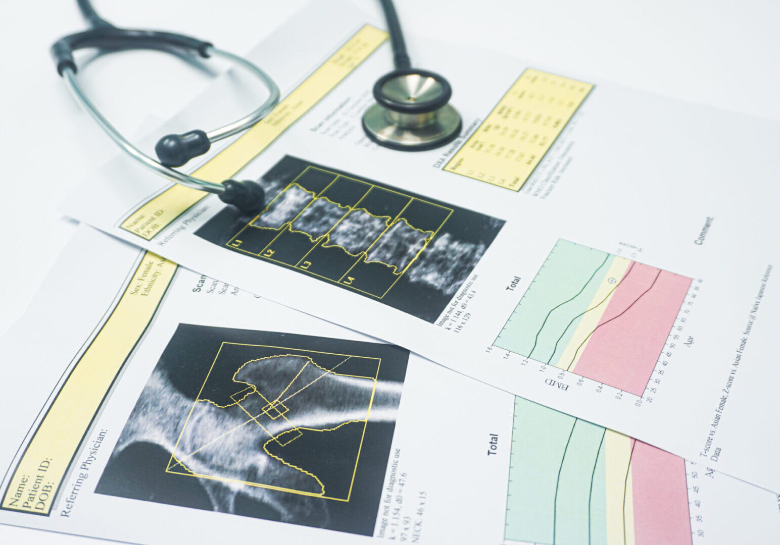 Estetoscopio encima de un reporte de un estudio de Densitometría Ósea con imágenes de cadera y columna vertebral.